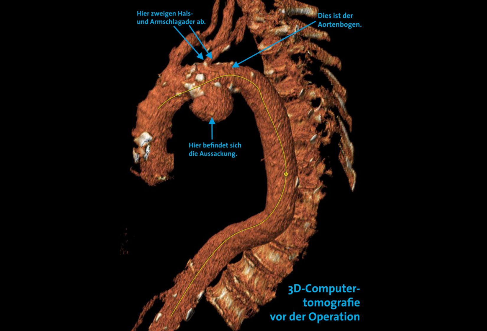 Aneurysma des Aortenbogens