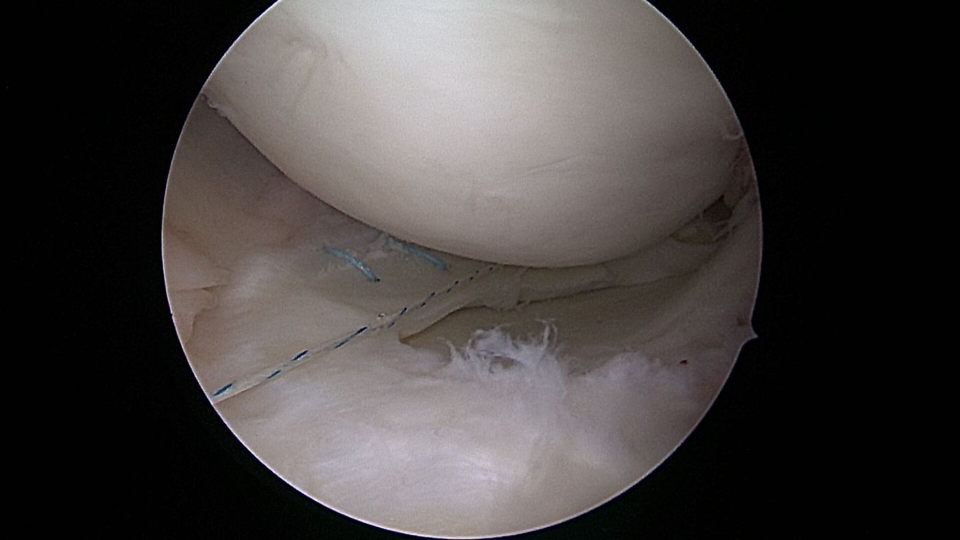 Arthroskopische Aufnahme eines genähten Korbhenkelrisses im Meniskus mit sichtbaren blauen Nahtankern, eine weitere Naht wird gesetzt.