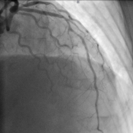 herzinfarkt-bild2-kardiologie-angiologie-waldkrankenhaus-erlangen