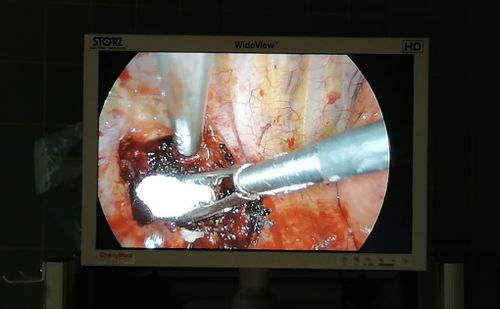 Endoskopische Aufnahme während eines chirurgischen Eingriffs, zwei Instrumente arbeiten im Gewebe mit Clip und Tamponade.