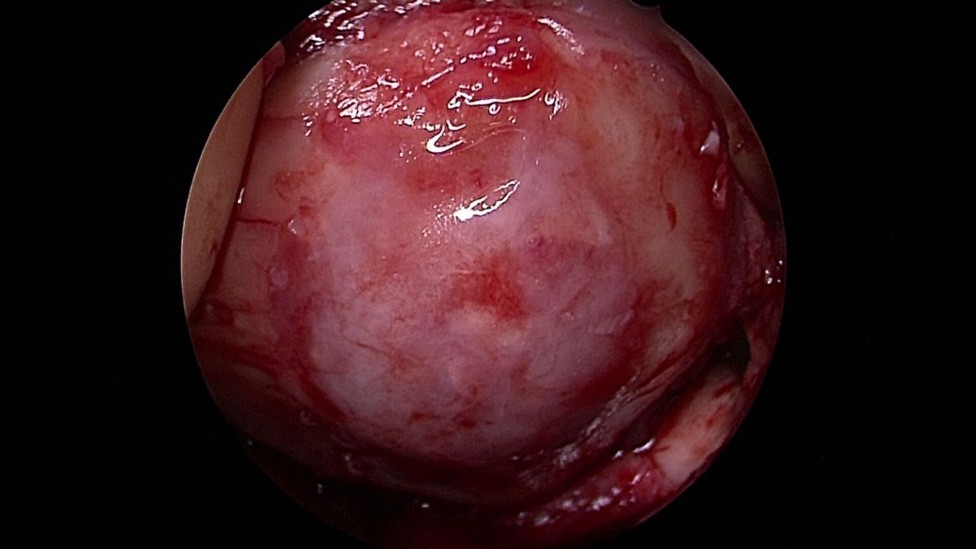 Arthroskopische Aufnahme nach Knorpeltherapie zeigt eine glatte, regenerierte Oberfläche im Gelenkbereich.