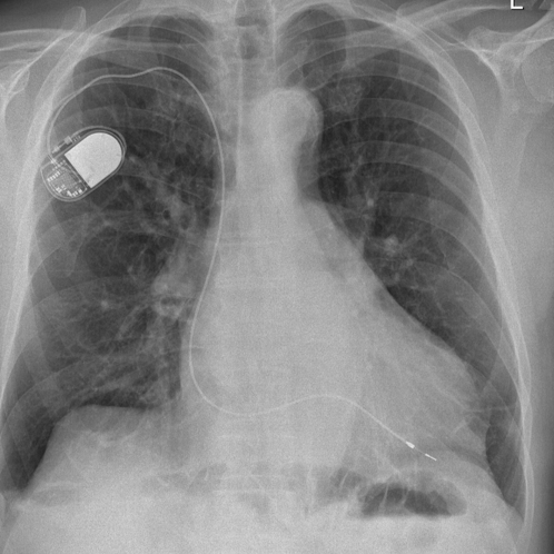 Röntgenbild des Brustkorbs mit Einkammer-Herzschrittmacher im linken oberen Brustbe-reich sichtbar.