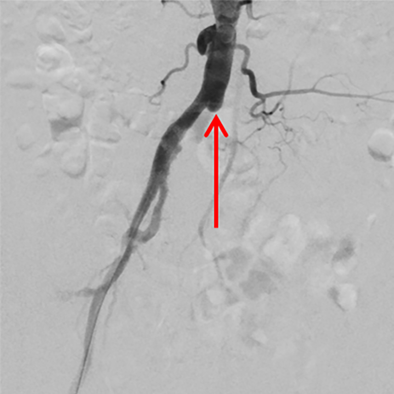 Röntgenbild mit Kontrastmittel zeigt Aortenverengung im Bauchbereich, markiert durch einen roten Pfeil.