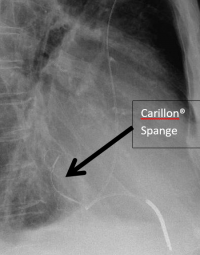 Röntgenaufnahme zeigt eine Carillon®-Spange zur Mitralinsuffizienztherapie, markiert mit schwarzem Pfeil.