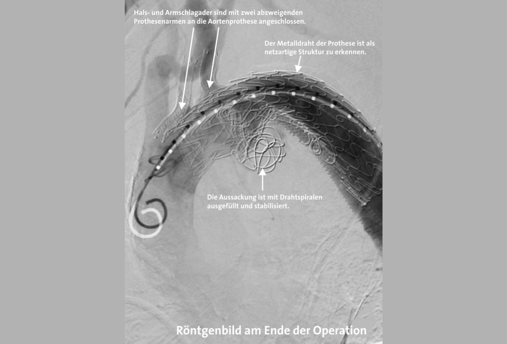 Aneurysma des Aortenbogens