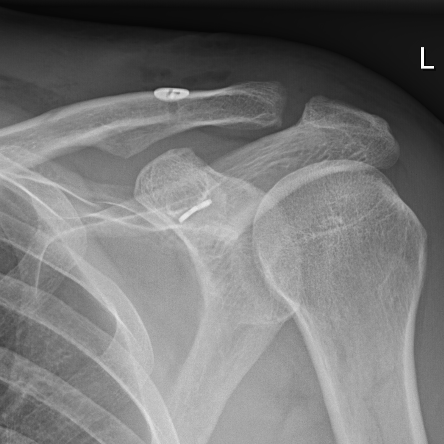 Röntgenaufnahme einer operativ stabilisierten Schultereckgelenkssprengung mit sichtbarer Fixation am Schlüsselbein durch Implantate.