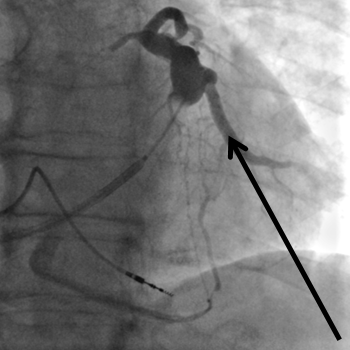 kontrastmitteldarstellung-herzvenen-kardiologie-angiologie-waldkrankenhaus