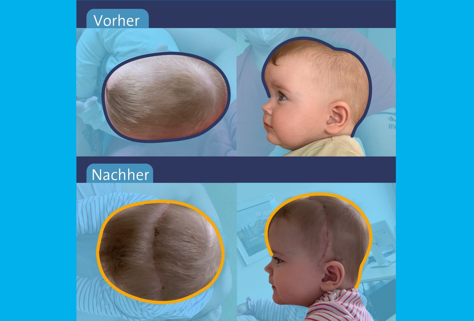 Abbild eines Schädelnahtverschluss