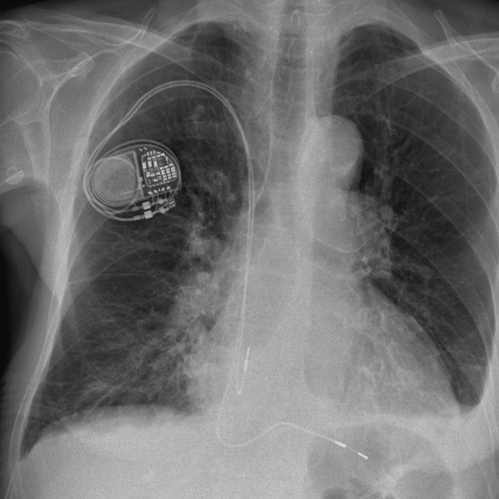 Röntgenbild des Brustkorbs mit Zweikammer-Herzschrittmacher im linken oberen Brustbereich sichtbar.