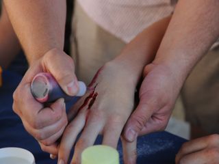 Beispiel einer Wunde