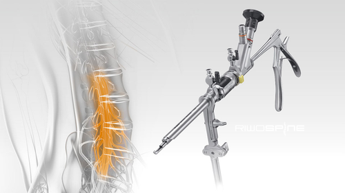 Endoskopieinstrument vor grafischer Wirbelsäulendarstellung mit markierten Nervenbahnen in Orange.