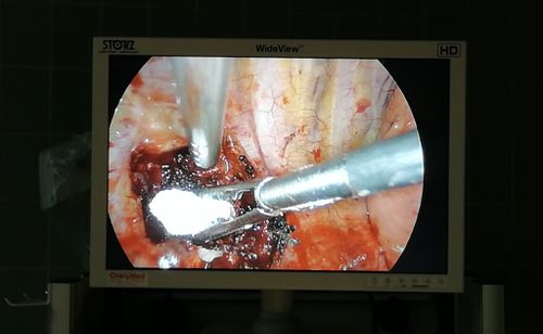 Endoskopische Aufnahme während eines chirurgischen Eingriffs, zwei Instrumente arbeiten im Gewebe mit Clip und Tamponade.