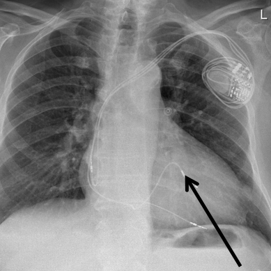 herzschrittmacher-mit-sonde-kardiologie-angiologie-waldkrankenhaus-erlangen