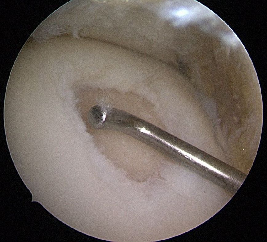 Arthroskopisches Bild zeigt einen Knorpelschaden im Gelenk, untersucht mit einem Me-tallinstrument zur Sondierung der betroffenen Stelle.