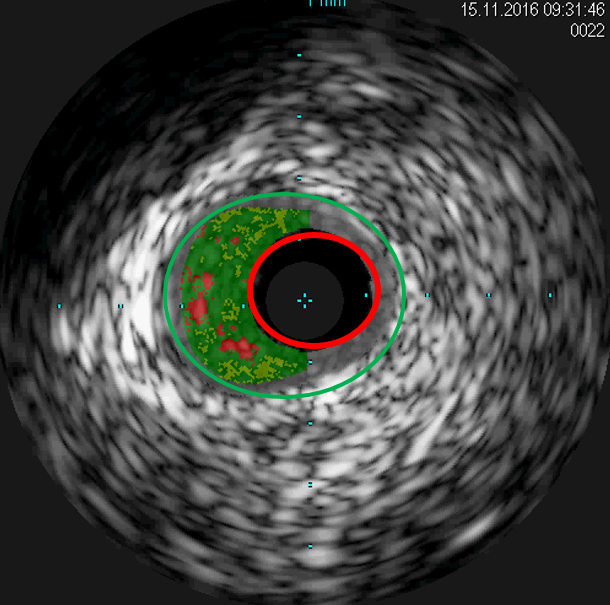 ivus1-kardiologie-angiologie-waldkrankenhaus-erlangen