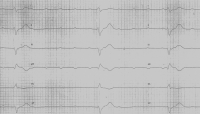 EKG-Aufzeichnung mit verlangsamtem Herzschlag durch Leitungsunterbrechung am AV-Knoten.