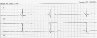 verlangsamter-herzschlag-kardiologie-angiologie-waldkrankenhaus-erlangen