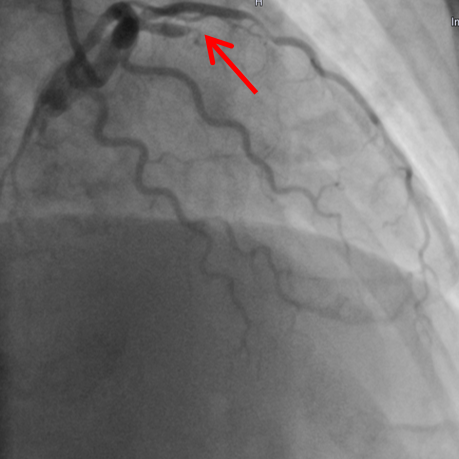 Röntgenbild der Herzkranzgefäße mit Verschluss des Vorderwandgefäßes bei Herzinfarkt, markiert durch roten Pfeil.