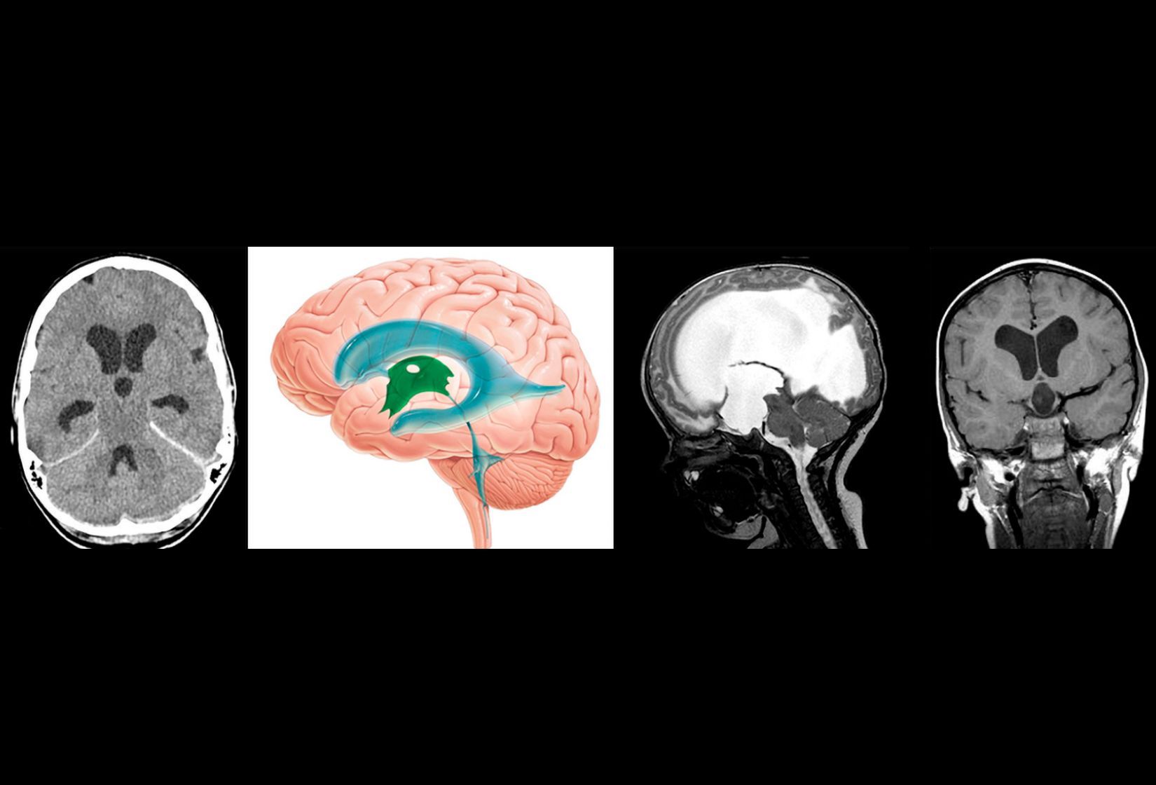 Hydrozephalus