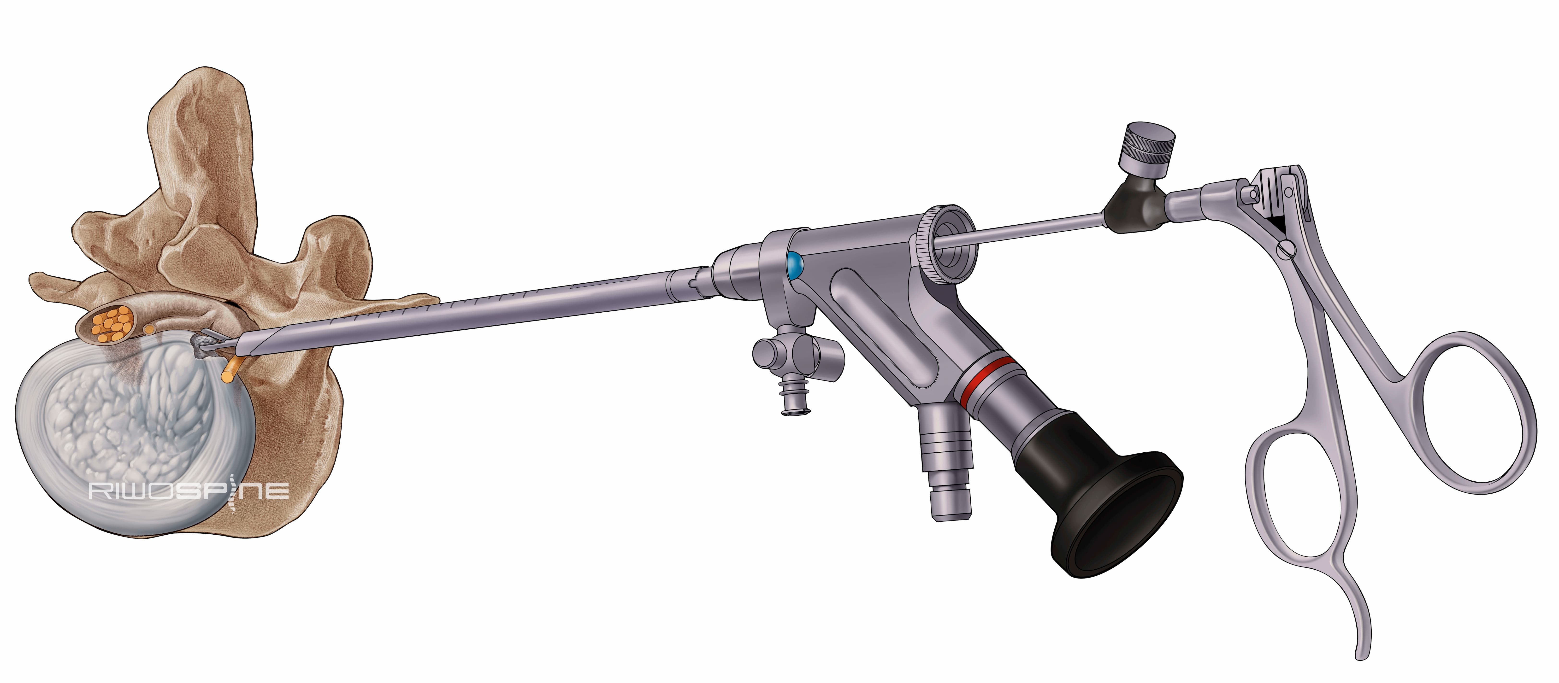 Illustration eines seitlich eingesetzten Endoskops mit Instrument zur Behandlung der Wirbelsäule.