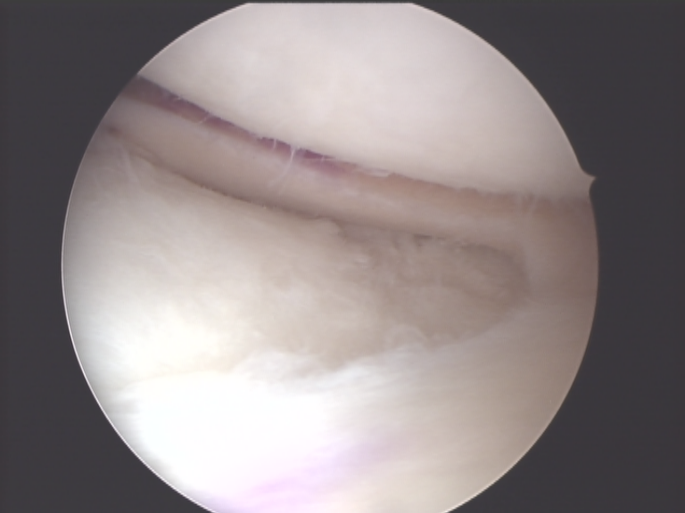 Arthroskopische Aufnahme eines transplantierten Meniskusallografts nach Fixierung im Kniegelenk.