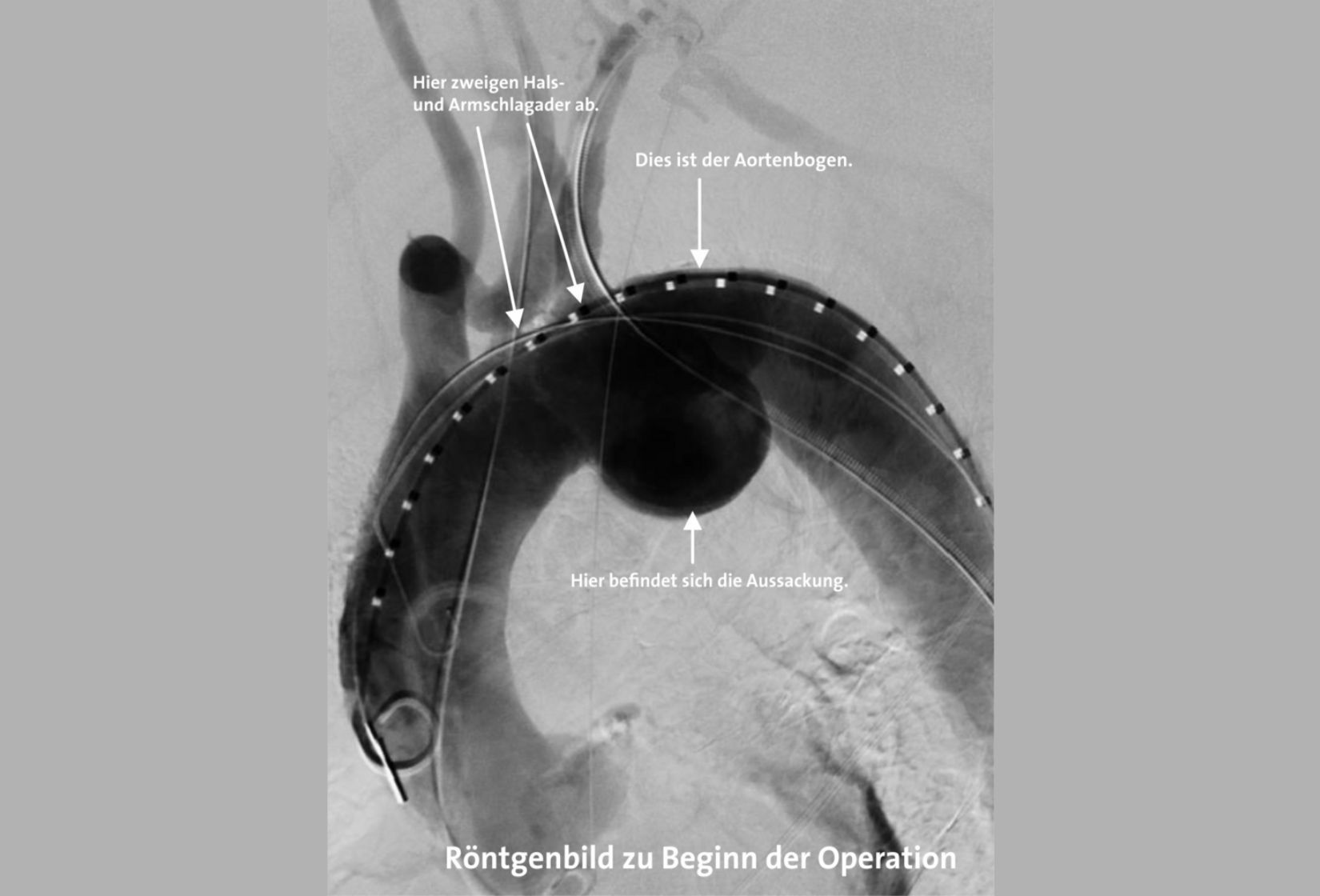 Aneurysma des Aortenbogens