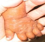Nahaufnahme der Hand eines Kindes mit sichtbaren Hautveränderungen.