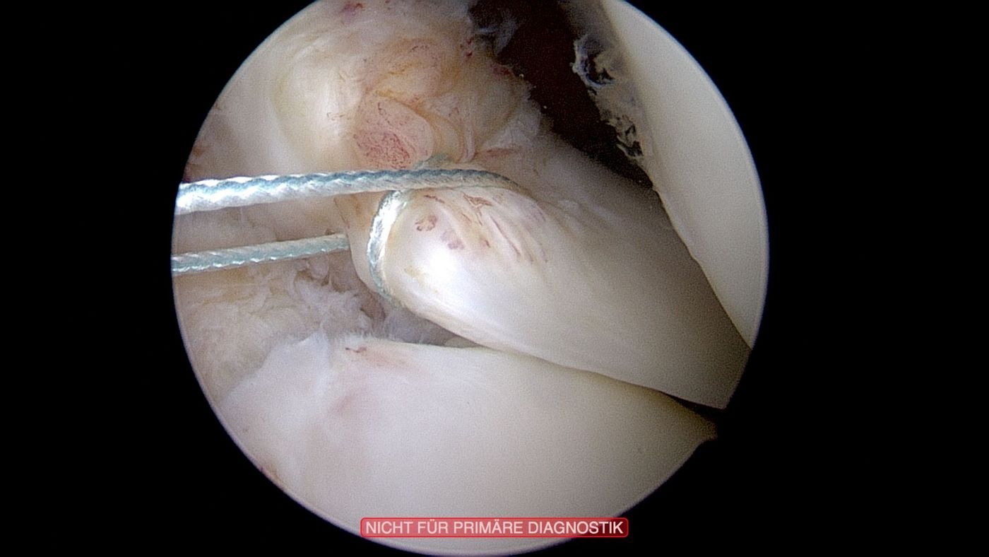 wurzelrefixation-orthopaedie-unfallchirurgie-waldkrankenhaus-erlangen