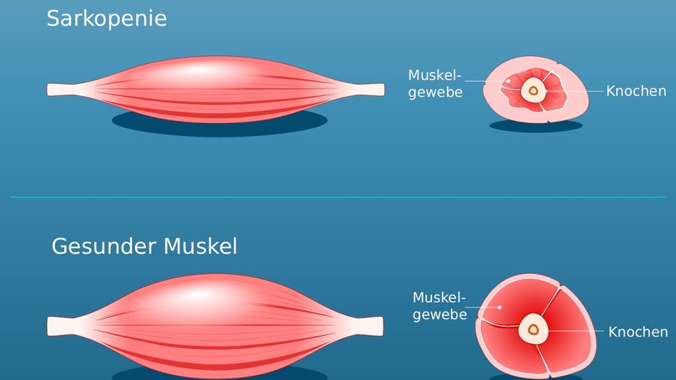 Illustration eines Muskels mit und ohne Sarkopenie.