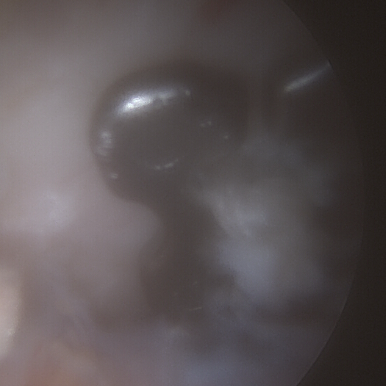 Arthroskopie des Schultereckgelenks mit sichtbarem Implantat zur Stabilisierung in Weichteilumgebung.