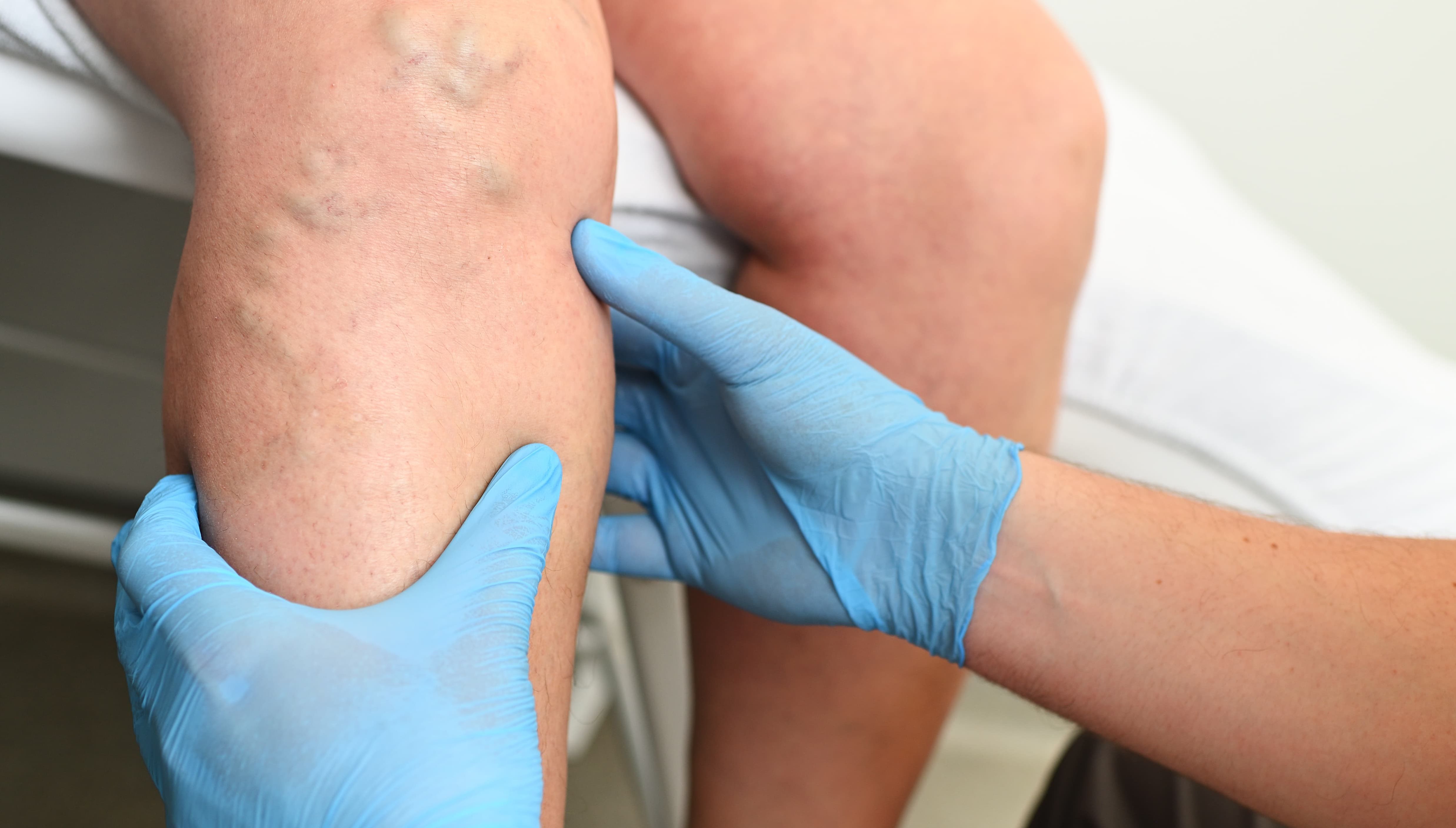Medizinische Fachkraft mit blauen Handschuhen untersucht das Bein einer Person mit Krampfadern.