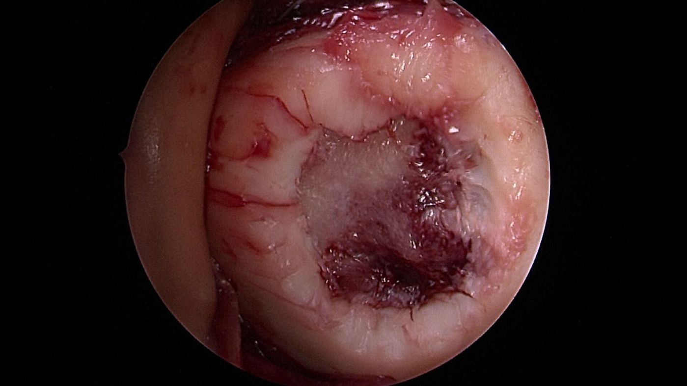 knorpeltransplantation-orthopaedie-unfallchirurgie-waldkrankenhaus-erlangen