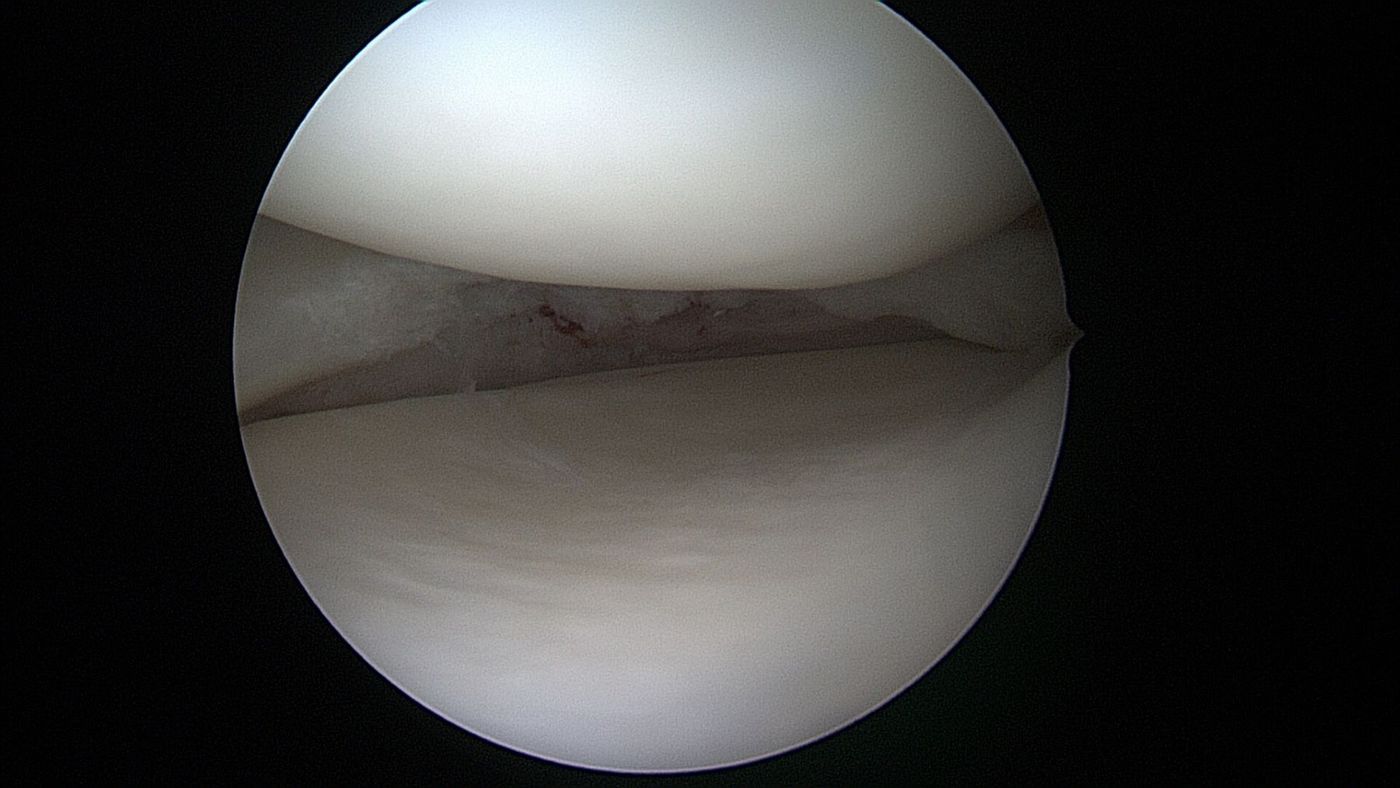 Arthroskopische Ansicht eines geglätteten Meniskusrisses nach Teilresektion im inneren, schlecht durchbluteten Bereich.