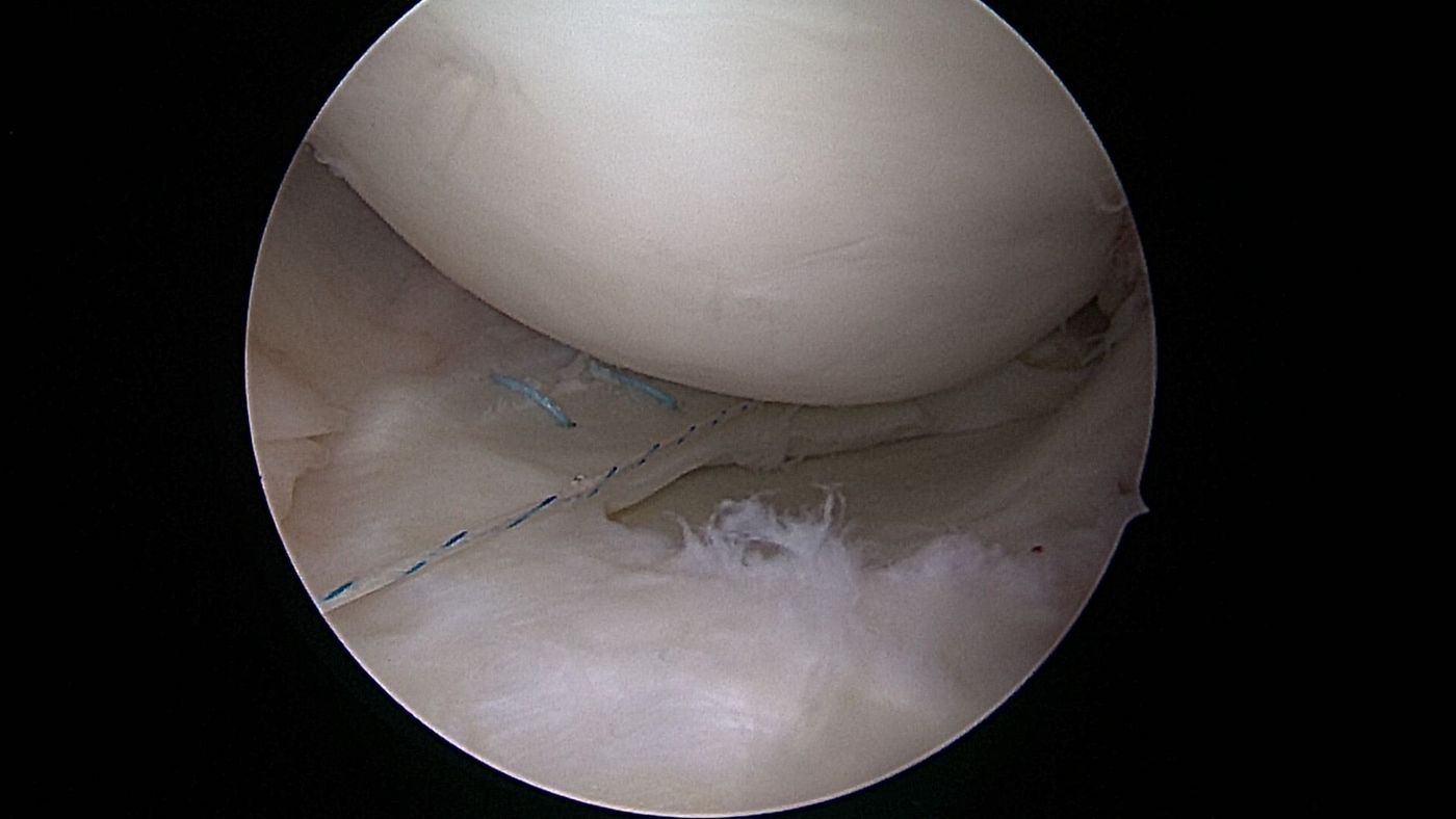 meniskusnaht-orthopaedie-unfallchirurgie-waldkrankenhaus-erlangen