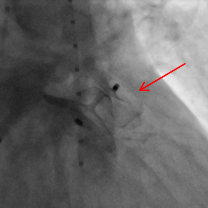 vorhofohr_bild-1b-kardiologie-angiologie-waldkrankenhaus-erlangen