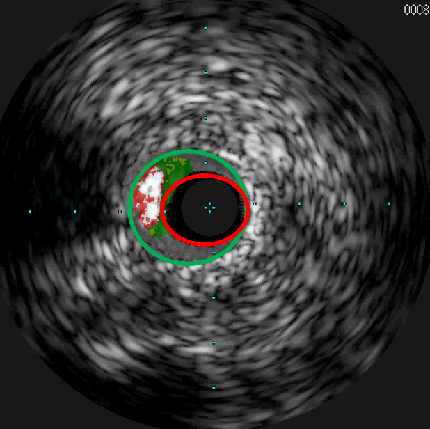 ivus2-kardiologie-angiologie-waldkrankenhaus-erlangen